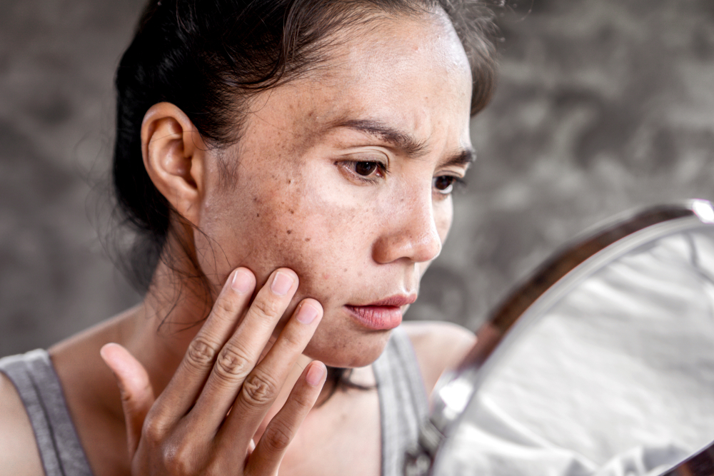 Mulher com melasma se olhando no espelho.