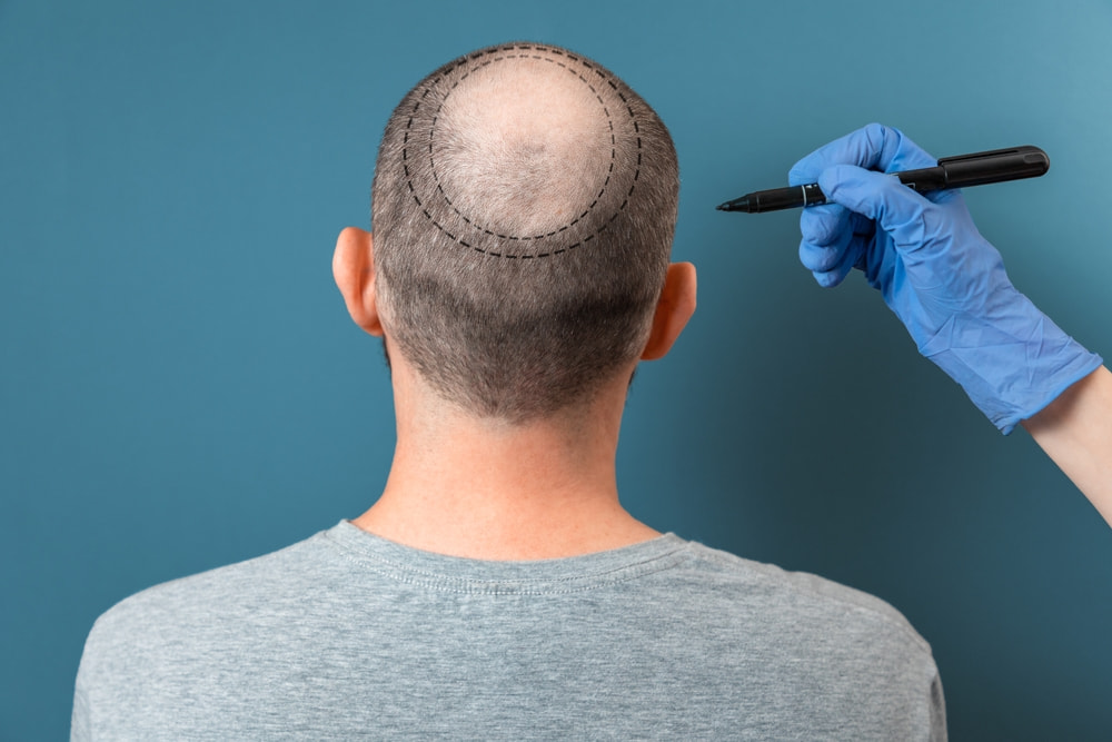 Homem de costas com a calvície marcada por caneta.