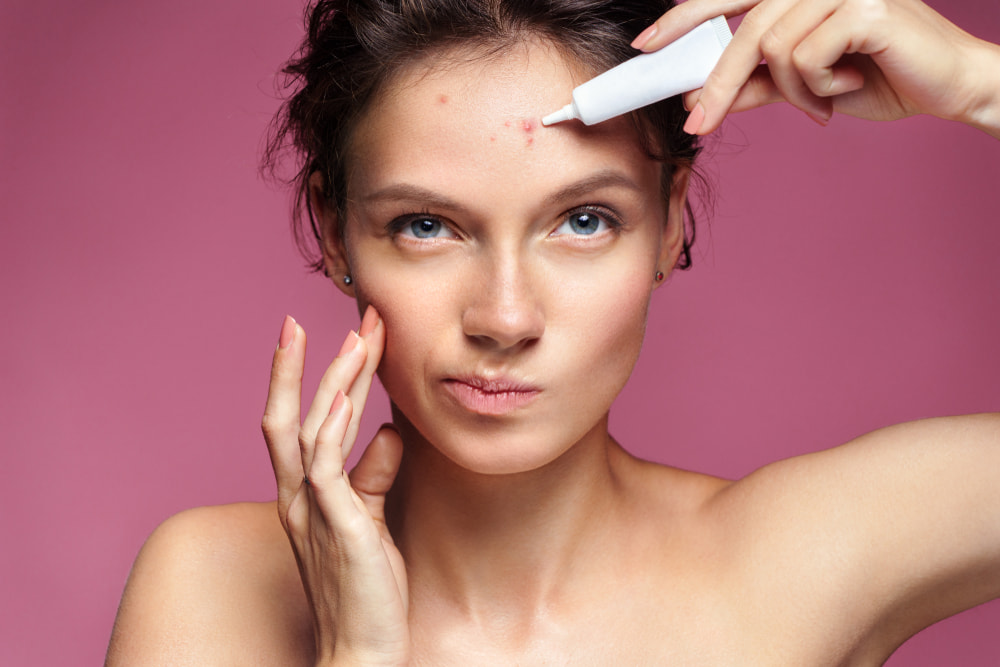 Garota apontando para sua acne e aplicando creme de tratamento